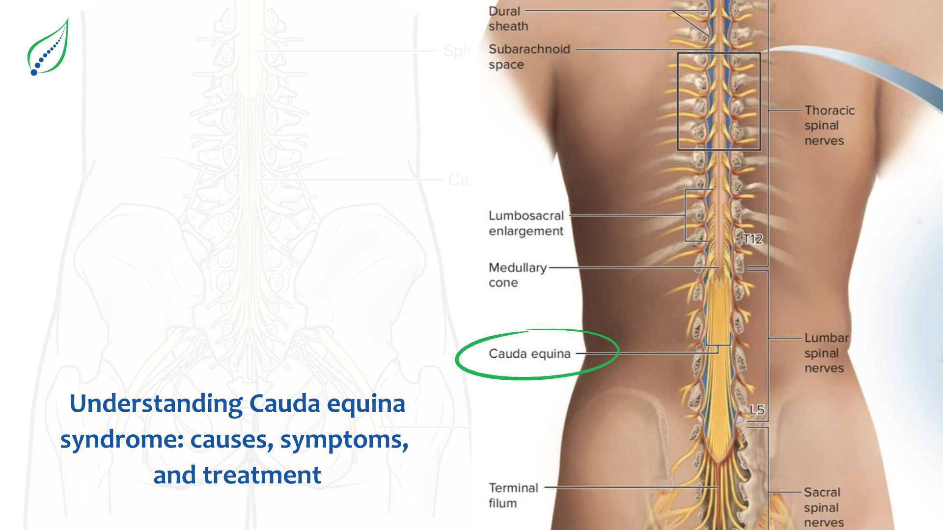 Understanding Cauda Equina Syndrome: Causes, Symptoms, and Nonsurgical Treatment